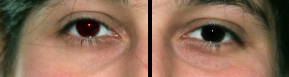 Rote augen 